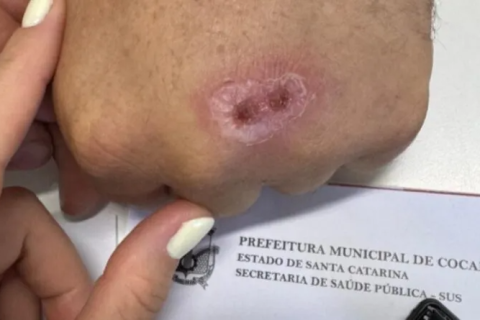 Doença transmitida por mordidas e arranhões de gatos é confirmada em cidade de SC